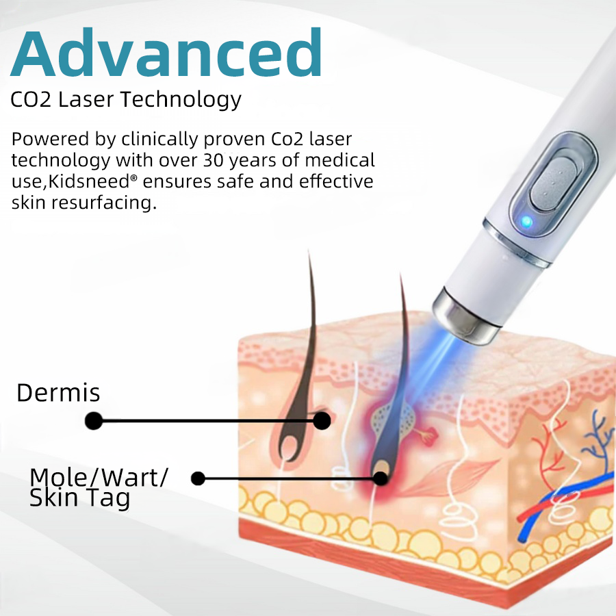Clinically Reviewed by Mayo Clinic Experts: 👩⚕️𝑲i𝒅sn𝒆𝒆𝒅® 𝑵on-i𝒏va𝒔𝒊ve 𝑴o𝒍e an𝒅 𝑾ar𝒕 𝑹emo𝒗𝒂𝒍 𝑳ase𝒓 𝑷en 𝑷roma𝒙 (Fast and painless removal of warts, moles, age spots, and skin tags — completely without side effects.)✈️