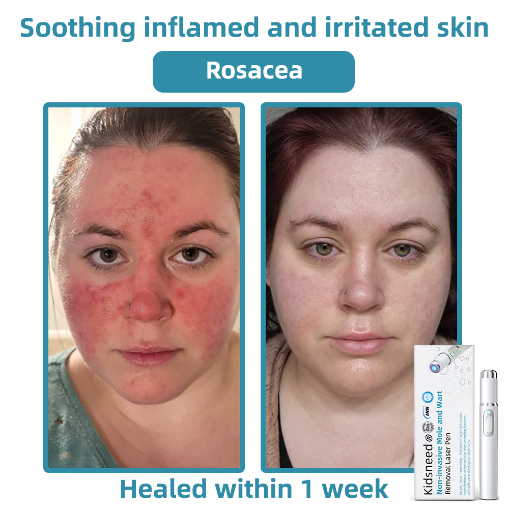 Clinically Reviewed by Mayo Clinic Experts: 👩⚕️𝑲i𝒅sn𝒆𝒆𝒅® 𝑵on-i𝒏va𝒔𝒊ve 𝑴o𝒍e an𝒅 𝑾ar𝒕 𝑹emo𝒗𝒂𝒍 𝑳ase𝒓 𝑷en 𝑷roma𝒙 (Fast and painless removal of warts, moles, age spots, and skin tags — completely without side effects.)✈️