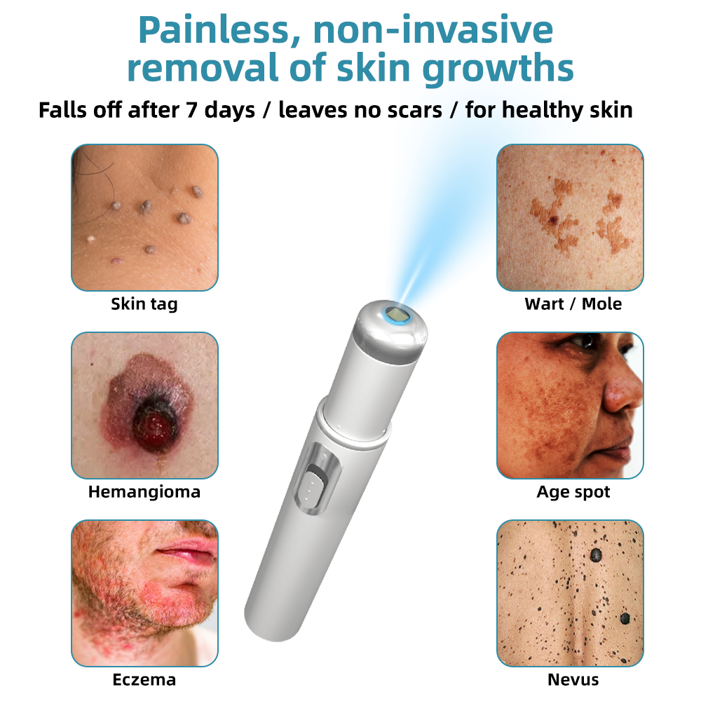 Clinically Reviewed by Mayo Clinic Experts: 👩⚕️𝑲i𝒅sn𝒆𝒆𝒅® 𝑵on-i𝒏va𝒔𝒊ve 𝑴o𝒍e an𝒅 𝑾ar𝒕 𝑹emo𝒗𝒂𝒍 𝑳ase𝒓 𝑷en 𝑷roma𝒙 (Fast and painless removal of warts, moles, age spots, and skin tags — completely without side effects.)✈️