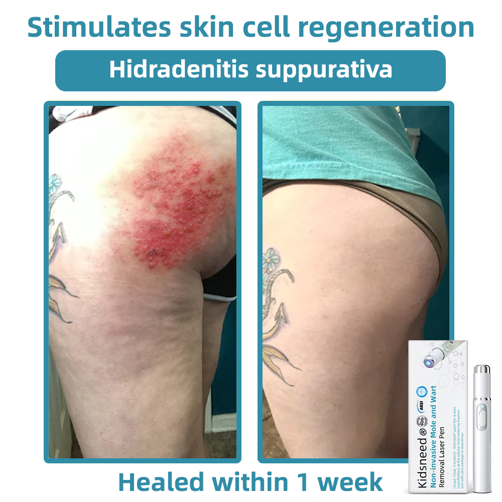 Clinically Reviewed by Mayo Clinic Experts: 👩⚕️𝑲i𝒅sn𝒆𝒆𝒅® 𝑵on-i𝒏va𝒔𝒊ve 𝑴o𝒍e an𝒅 𝑾ar𝒕 𝑹emo𝒗𝒂𝒍 𝑳ase𝒓 𝑷en 𝑷roma𝒙 (Fast and painless removal of warts, moles, age spots, and skin tags — completely without side effects.)✈️