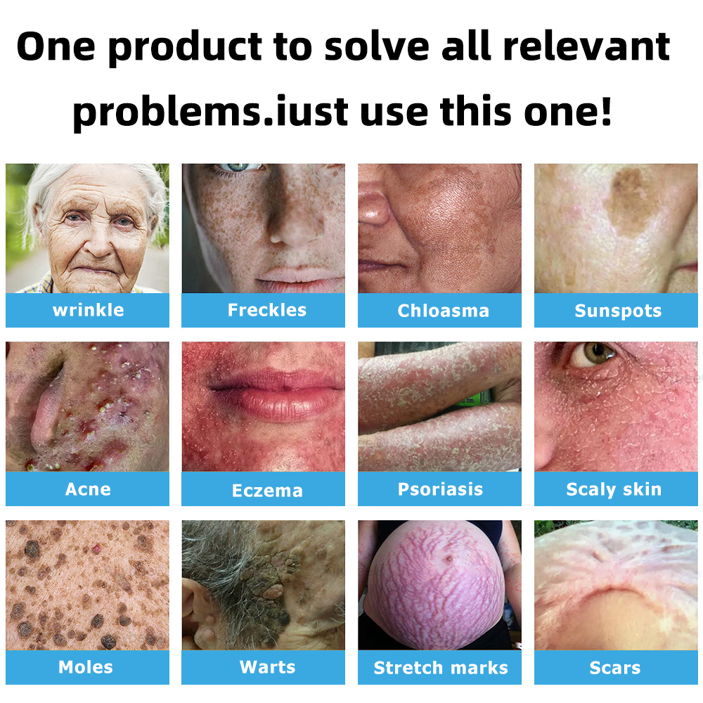 Clinically Reviewed by Mayo Clinic Experts: 👩⚕️𝑲i𝒅sn𝒆𝒆𝒅® 𝑵on-i𝒏va𝒔𝒊ve 𝑴o𝒍e an𝒅 𝑾ar𝒕 𝑹emo𝒗𝒂𝒍 𝑳ase𝒓 𝑷en 𝑷roma𝒙 (Fast and painless removal of warts, moles, age spots, and skin tags — completely without side effects.)✈️