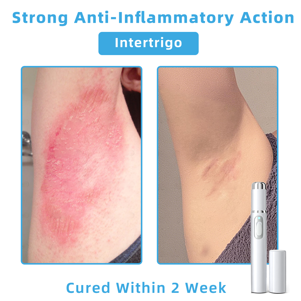 Clinically Reviewed by Mayo Clinic Experts: 👩⚕️𝑲i𝒅sn𝒆𝒆𝒅® 𝑵on-i𝒏va𝒔𝒊ve 𝑴o𝒍e an𝒅 𝑾ar𝒕 𝑹emo𝒗𝒂𝒍 𝑳ase𝒓 𝑷en 𝑷roma𝒙 (Fast and painless removal of warts, moles, age spots, and skin tags — completely without side effects.)✈️