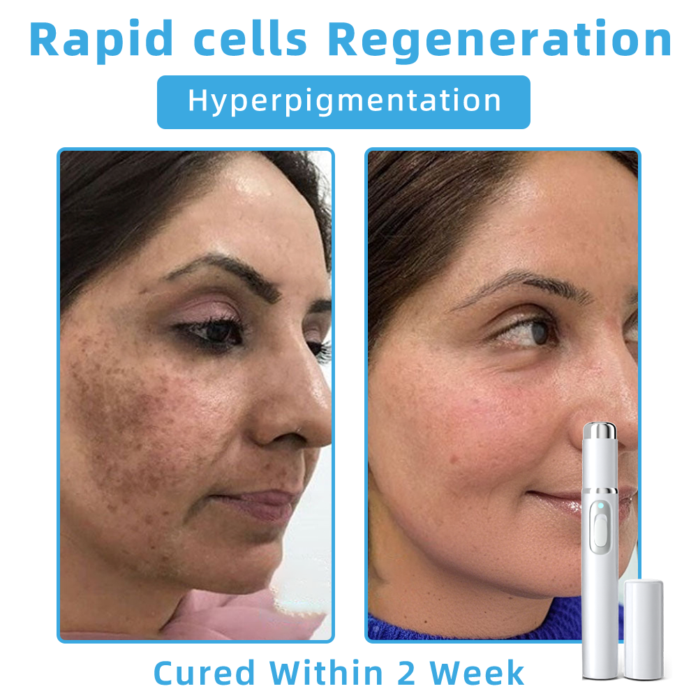 Clinically Reviewed by Mayo Clinic Experts: 👩⚕️𝑲i𝒅sn𝒆𝒆𝒅® 𝑵on-i𝒏va𝒔𝒊ve 𝑴o𝒍e an𝒅 𝑾ar𝒕 𝑹emo𝒗𝒂𝒍 𝑳ase𝒓 𝑷en 𝑷roma𝒙 (Fast and painless removal of warts, moles, age spots, and skin tags — completely without side effects.)✈️