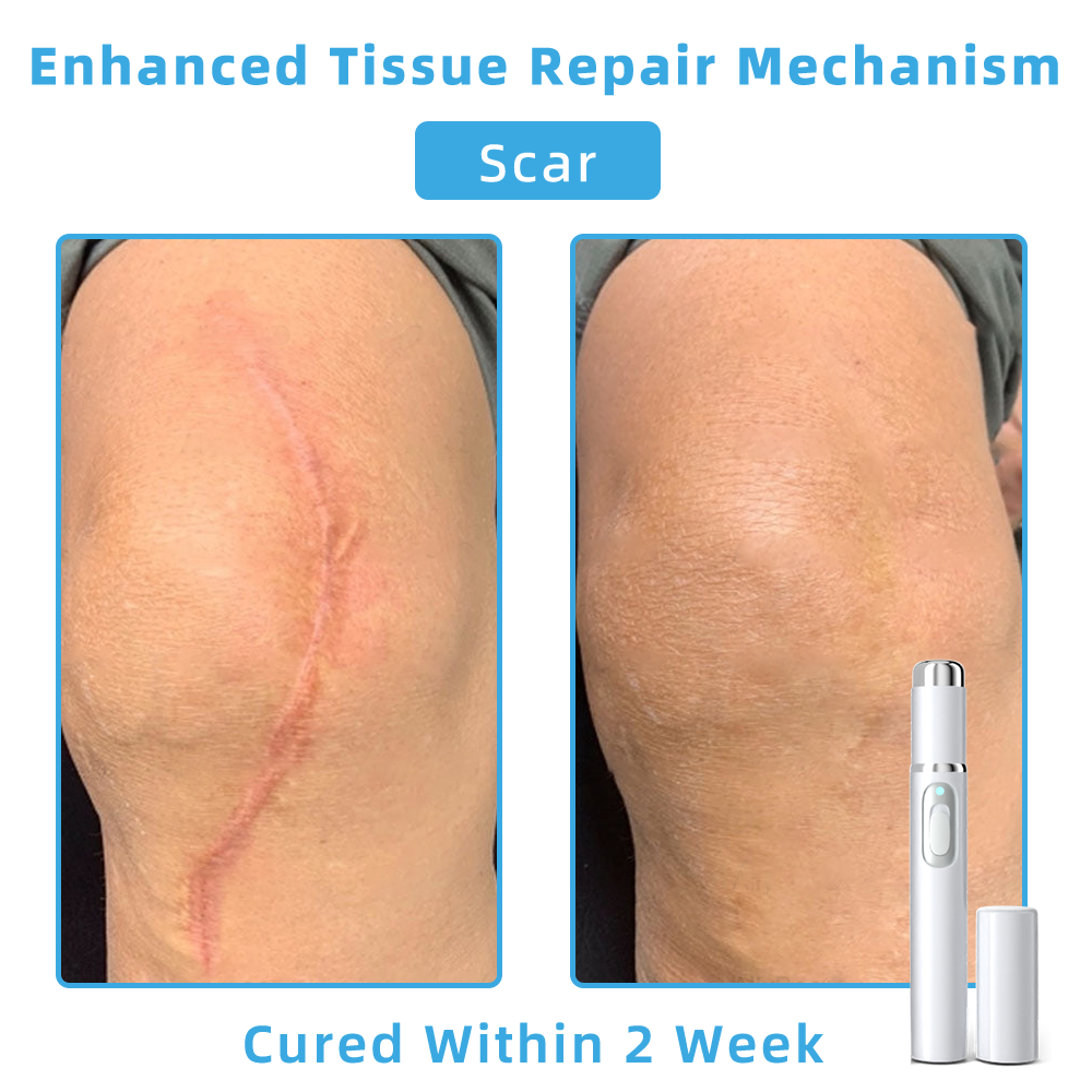 Clinically Reviewed by Mayo Clinic Experts: 👩⚕️𝑲i𝒅sn𝒆𝒆𝒅® 𝑵on-i𝒏va𝒔𝒊ve 𝑴o𝒍e an𝒅 𝑾ar𝒕 𝑹emo𝒗𝒂𝒍 𝑳ase𝒓 𝑷en 𝑷roma𝒙 (Fast and painless removal of warts, moles, age spots, and skin tags — completely without side effects.)✈️