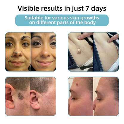 Clinically Reviewed by Mayo Clinic Experts: 👩‍⚕️𝑲i𝒅sn𝒆𝒆𝒅® 𝑵on-i𝒏va𝒔𝒊ve 𝑴o𝒍e an𝒅 𝑾ar𝒕 𝑹emo𝒗𝒂𝒍 𝑳ase𝒓 𝑷en 𝑷roma𝒙 （Fast and painless removal of warts, moles, age spots, and skin tags — completely without side effects.）✈️