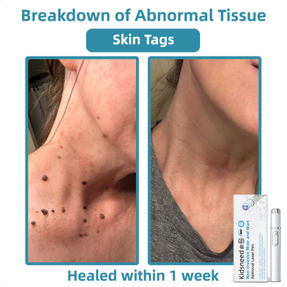 Clinically Reviewed by Mayo Clinic Experts: 👩‍⚕️𝑲i𝒅sn𝒆𝒆𝒅® 𝑵on-i𝒏va𝒔𝒊ve 𝑴o𝒍e an𝒅 𝑾ar𝒕 𝑹emo𝒗𝒂𝒍 𝑳ase𝒓 𝑷en 𝑷roma𝒙 （Fast and painless removal of warts, moles, age spots, and skin tags — completely without side effects.）✈️