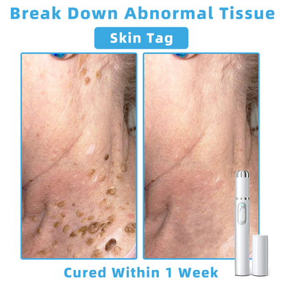 Clinically Reviewed by Mayo Clinic Experts: 👩‍⚕️𝑲i𝒅sn𝒆𝒆𝒅® 𝑵on-i𝒏va𝒔𝒊ve 𝑴o𝒍e an𝒅 𝑾ar𝒕 𝑹emo𝒗𝒂𝒍 𝑳ase𝒓 𝑷en 𝑷roma𝒙 （Fast and painless removal of warts, moles, age spots, and skin tags — completely without side effects.）✈️
