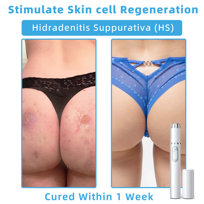 Clinically Reviewed by Mayo Clinic Experts: 👩‍⚕️𝑲i𝒅sn𝒆𝒆𝒅® 𝑵on-i𝒏va𝒔𝒊ve 𝑴o𝒍e an𝒅 𝑾ar𝒕 𝑹emo𝒗𝒂𝒍 𝑳ase𝒓 𝑷en 𝑷roma𝒙 （Fast and painless removal of warts, moles, age spots, and skin tags — completely without side effects.）✈️